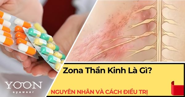 Zona Thần Kinh Là Gì? Nguyên Nhân, Triệu Chứng & Cách Điều Trị