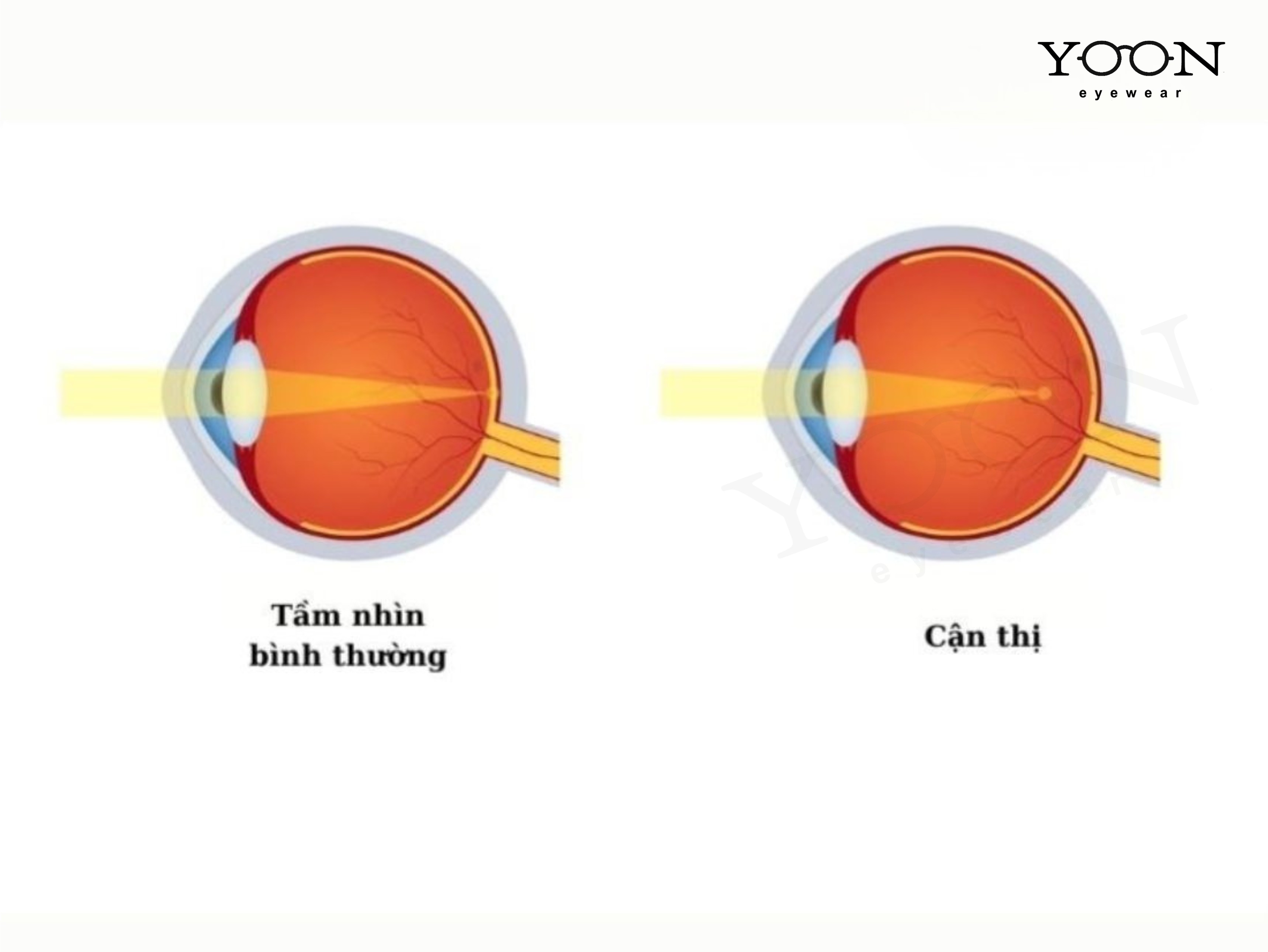 CẬN THỊ LÀ GÌ? TẠI SAO MẮT BỊ CẬN?