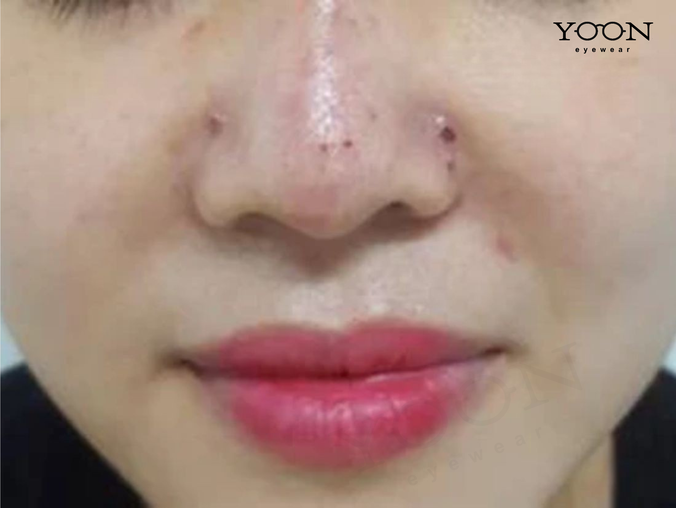 DẤU HIỆU CẢNH BÁO BIẾN CHỨNG SAU KHI TIÊM FILLER