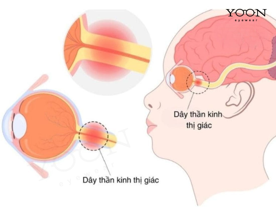 DÂY THẦN KINH THỊ GIÁC CÓ VAI TRÒ GÌ?
