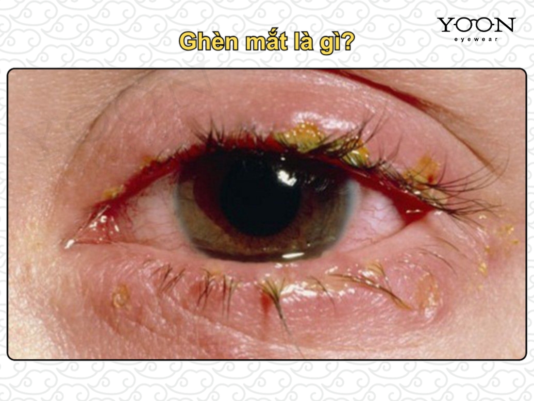 GHÈN MẮT LÀ GÌ?