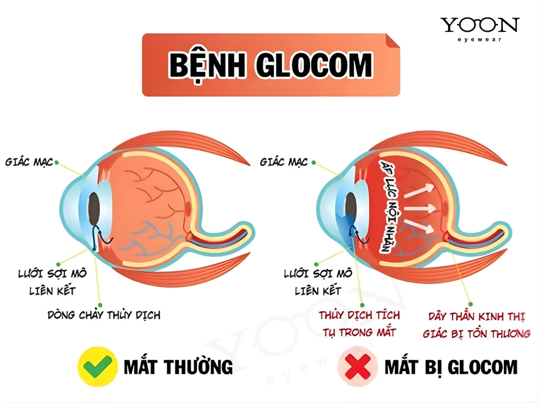 GLOCOM GÓC ĐÓNG LÀ GÌ?