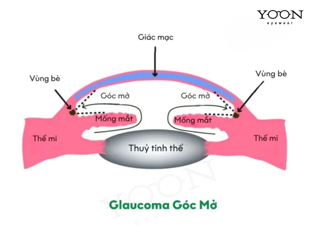 GLOCOM GÓC MỞ LÀ GÌ?