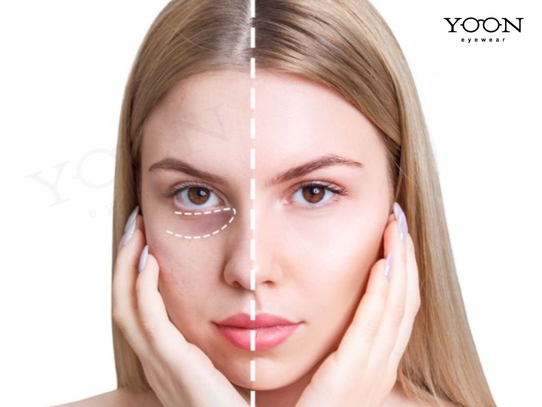 HỐC MẮT SÂU ẢNH HƯỞNG ĐẾN NGOẠI HÌNH NHƯ THẾ NÀO?