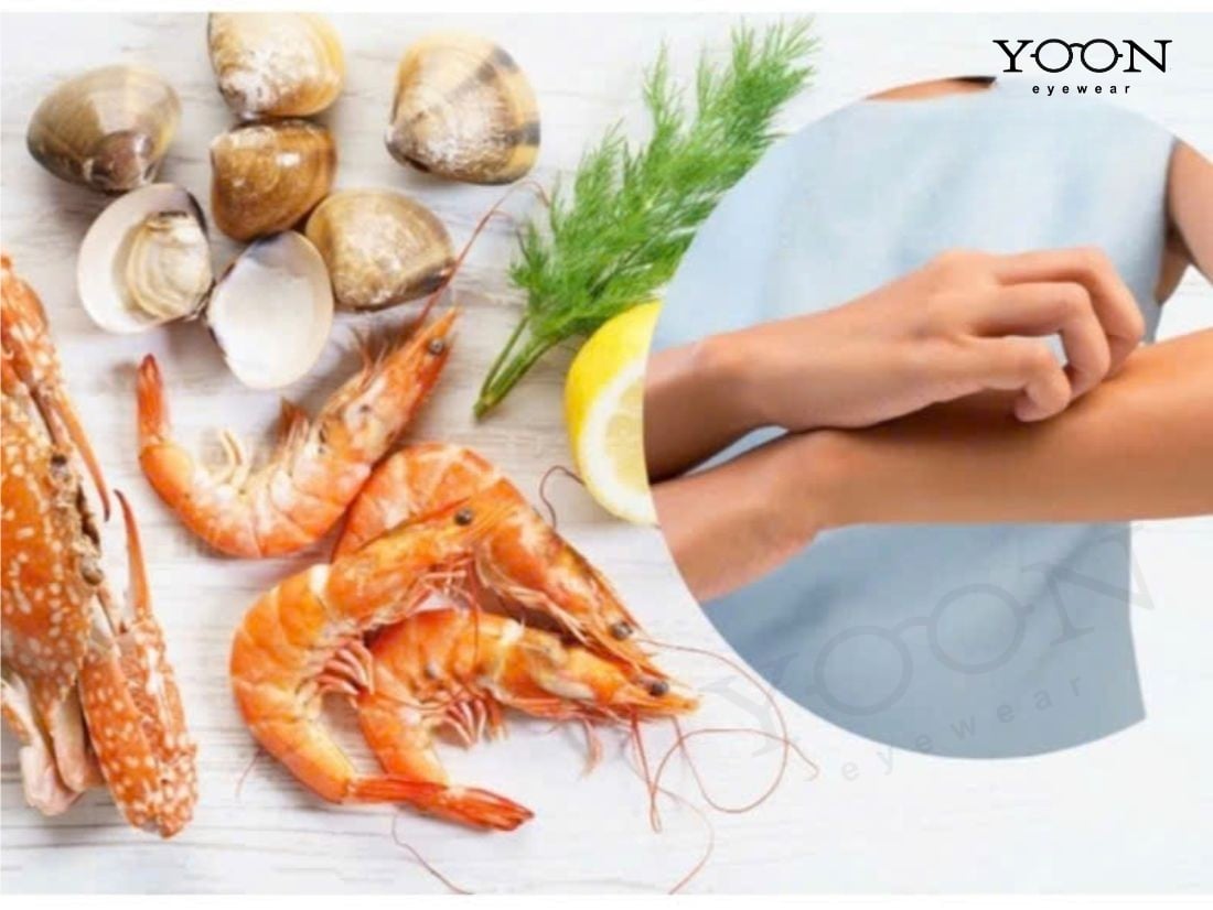Hải Sản Dễ Gây Dị Ứng