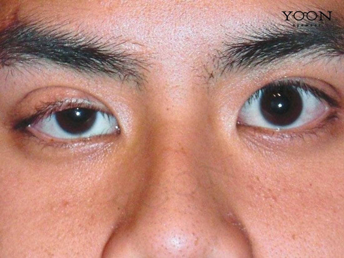 KHÁI QUÁT VỀ BỆNH NHƯỢC CƠ