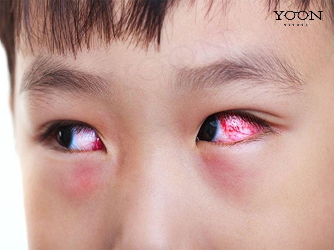 KHI NÀO MẠCH MÁU TRÊN MẮT LÀ DẤU HIỆU CẦN CHÚ Ý?