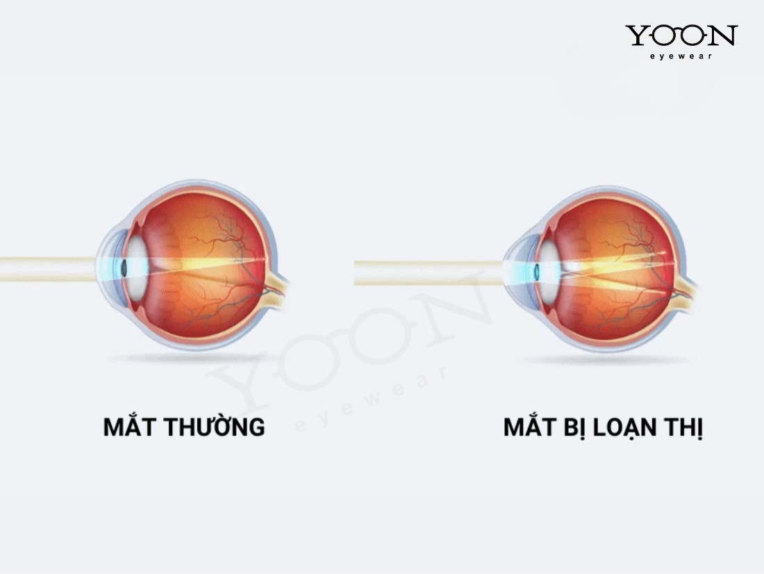 LOẠN THỊ CÓ TĂNG ĐỘ KHÔNG?
