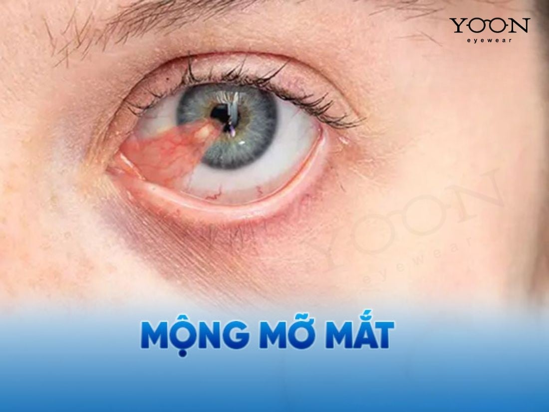 MỘNG THỊT Ở MẮT LÀ GÌ?