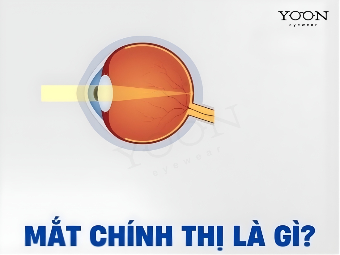 MẮT CHÍNH THỊ LÀ GÌ?