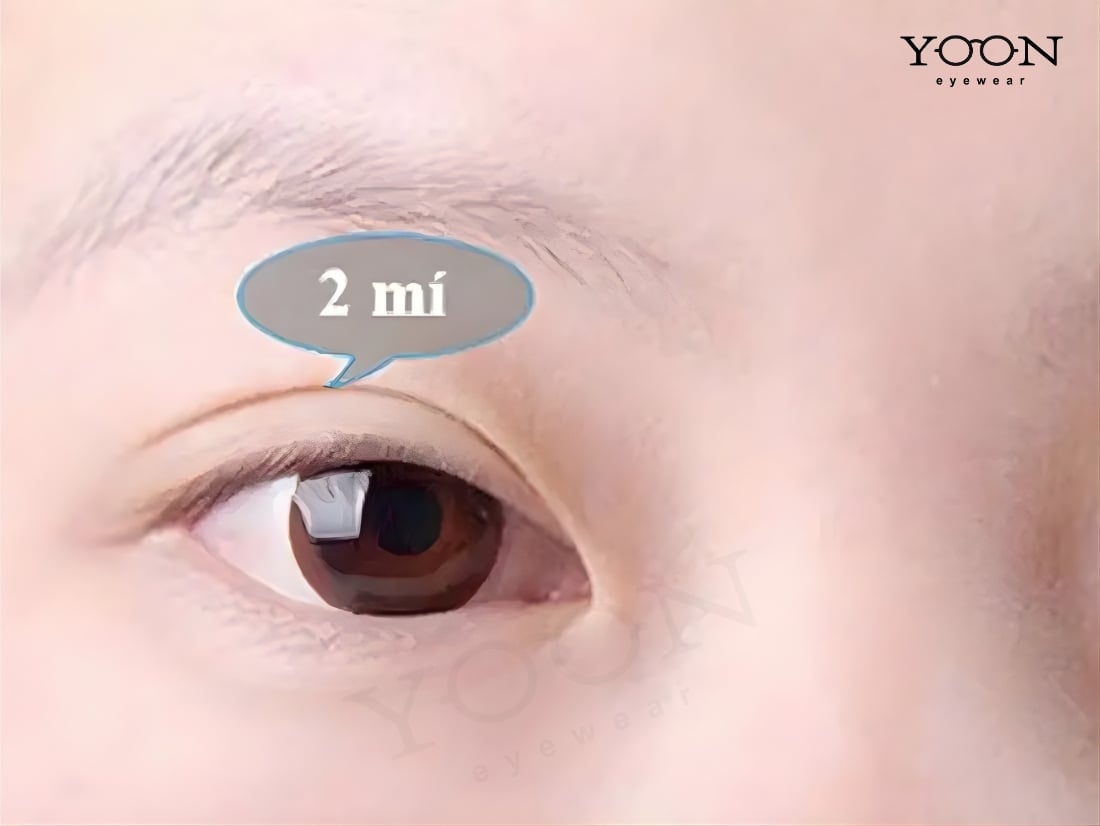 MẮT HAI MÍ LÀ GÌ?