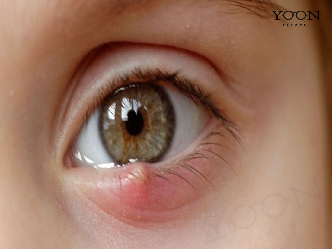 Nguyên nhân gây viêm bờ mi trên, dị ứng