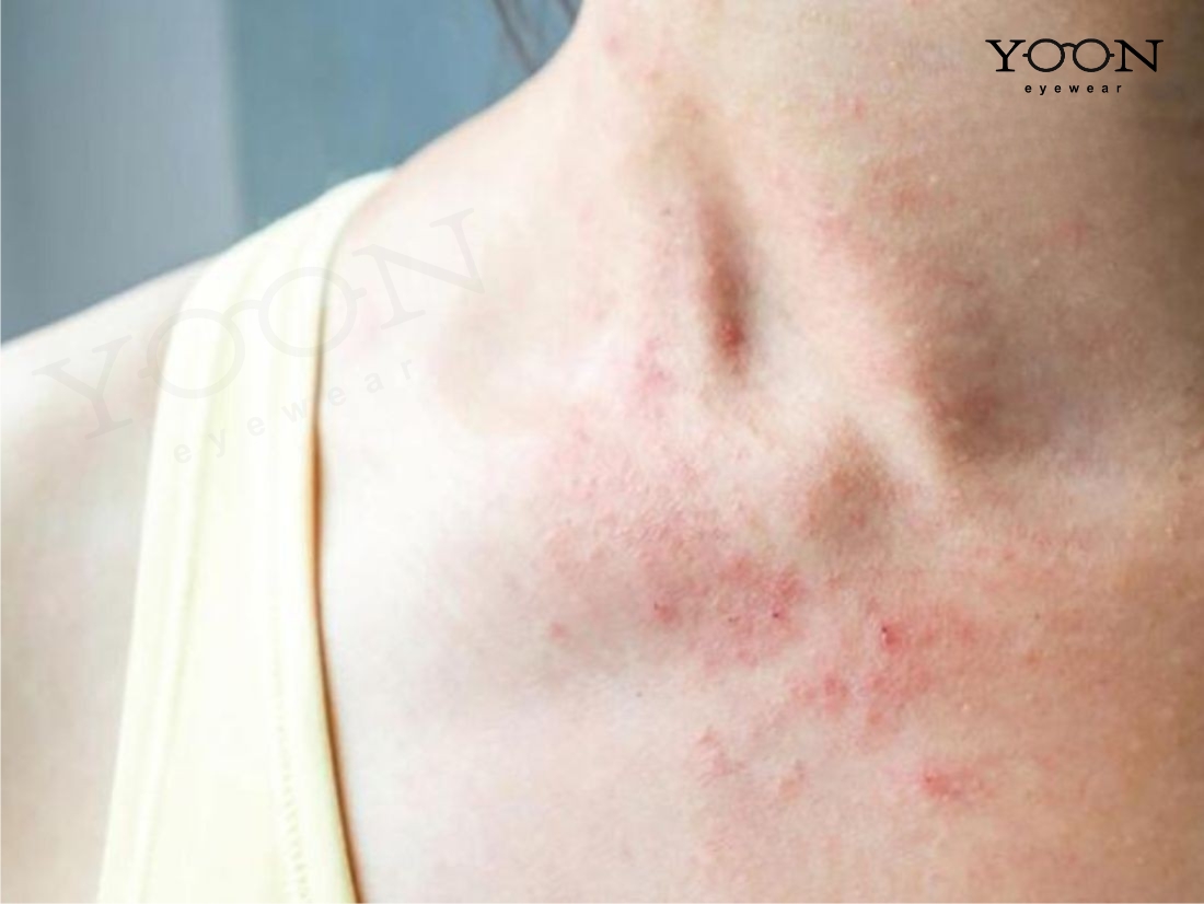 NGUYÊN NHÂN GÂY RA ZONA THẦN KINH