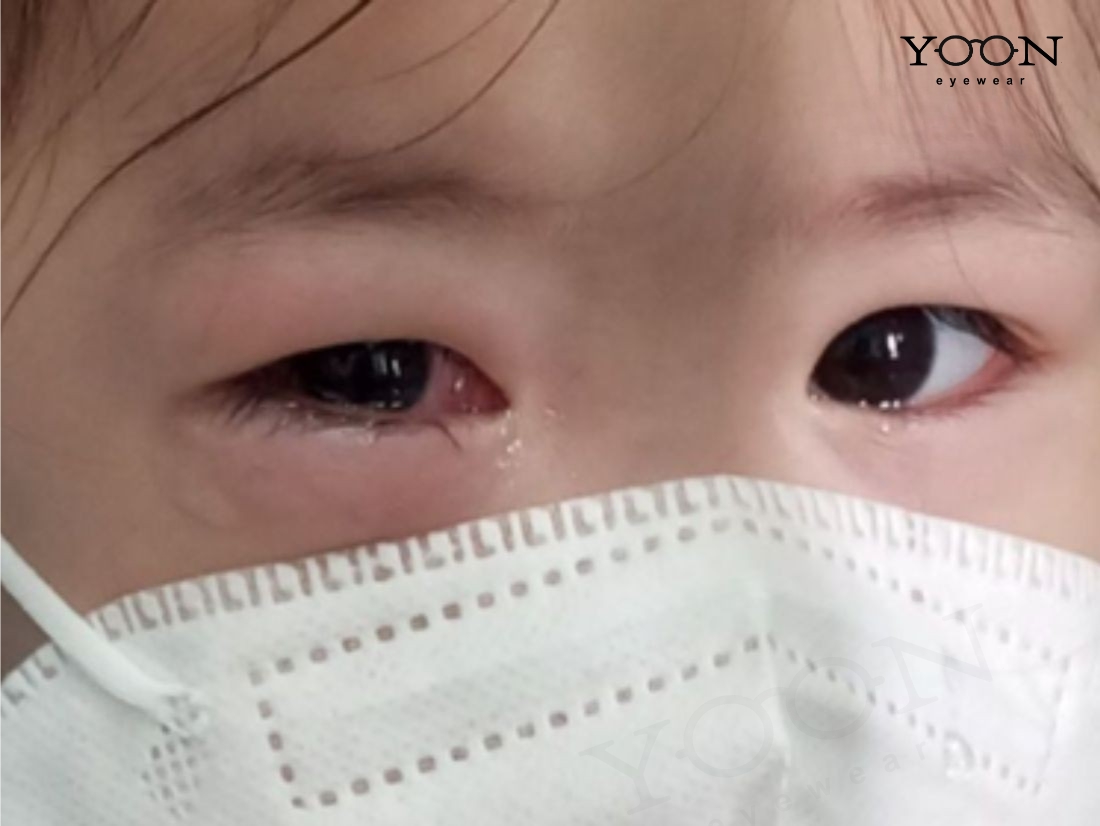 NGUYÊN NHÂN KHIẾN MẮT CÓ NHIỀU GHÈN SAU KHI NGỦ DẬY
