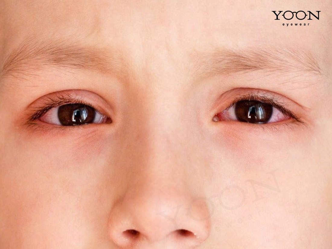 NGUYÊN NHÂN KHIẾN MẮT TRẺ BỊ ĐỔ GHÈN