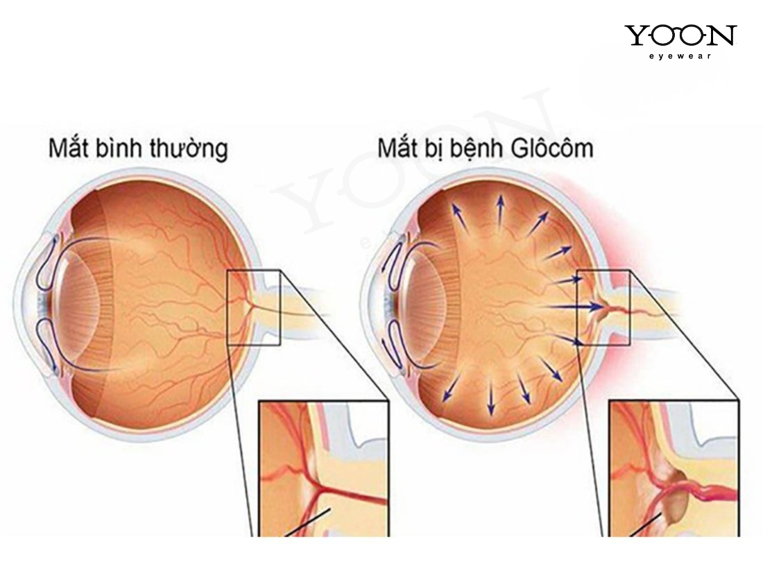 PHÂN LOẠI BỆNH GLOCOM GÓC ĐÓNG
