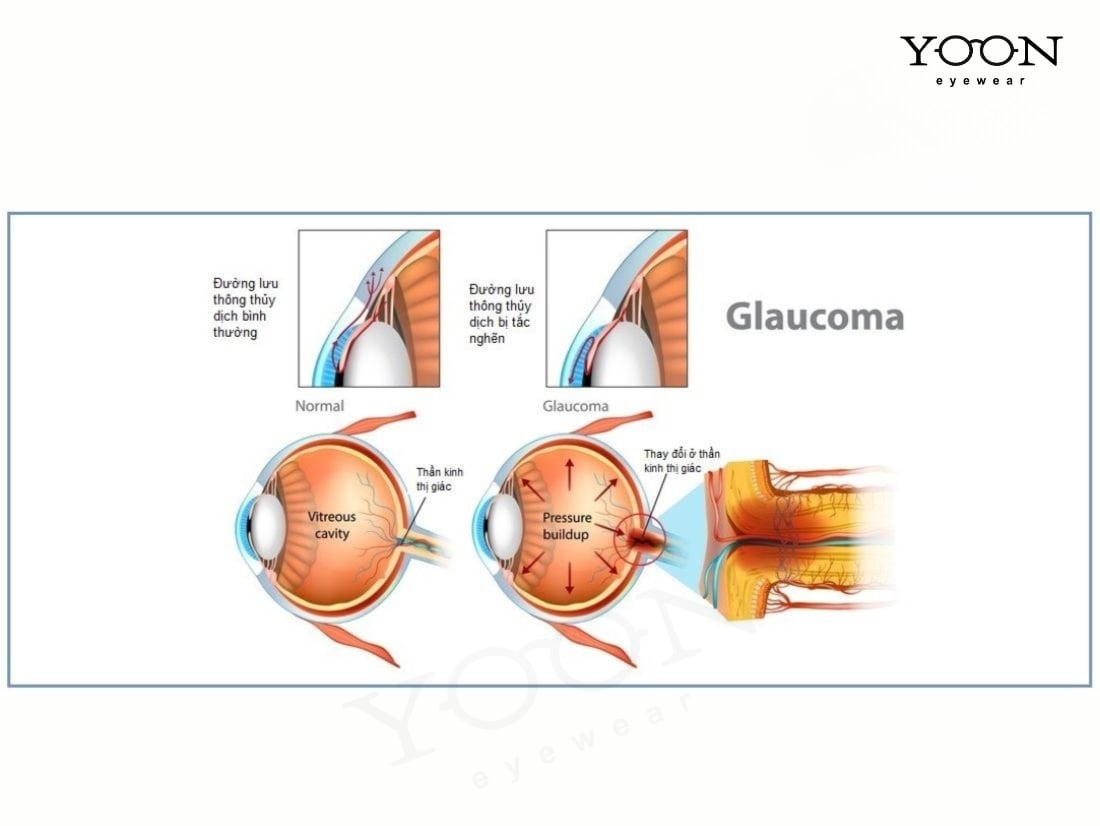 PHÂN LOẠI GLOCOM GÓC MỞ