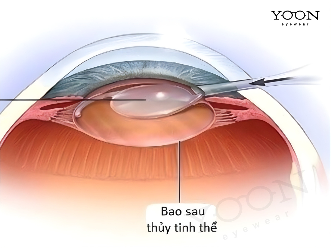 Phẫu Thuật Thủy Tinh Thể Trong Bao