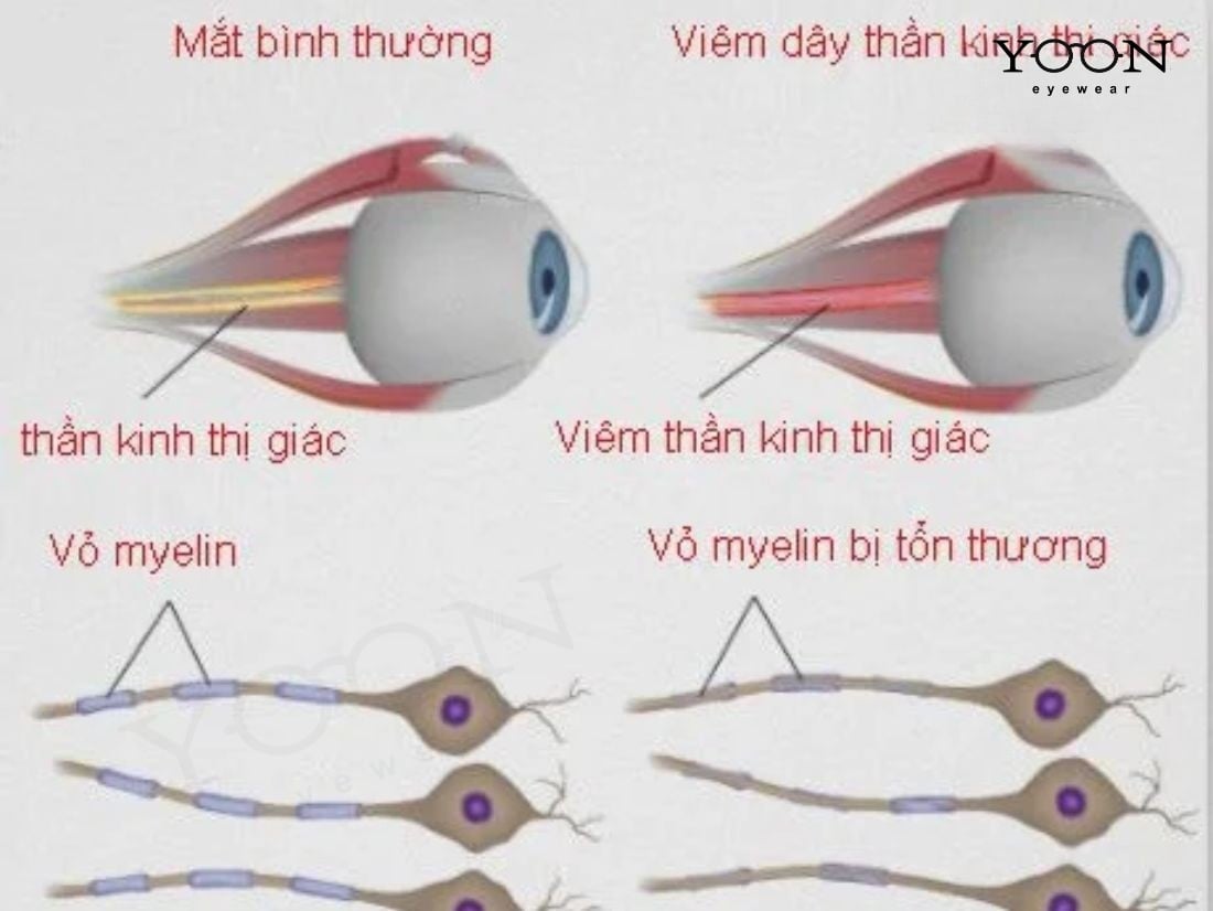 PHỤC HỒI DÂY THẦN KINH THỊ GIÁC CÓ KHẢ THI KHÔNG?