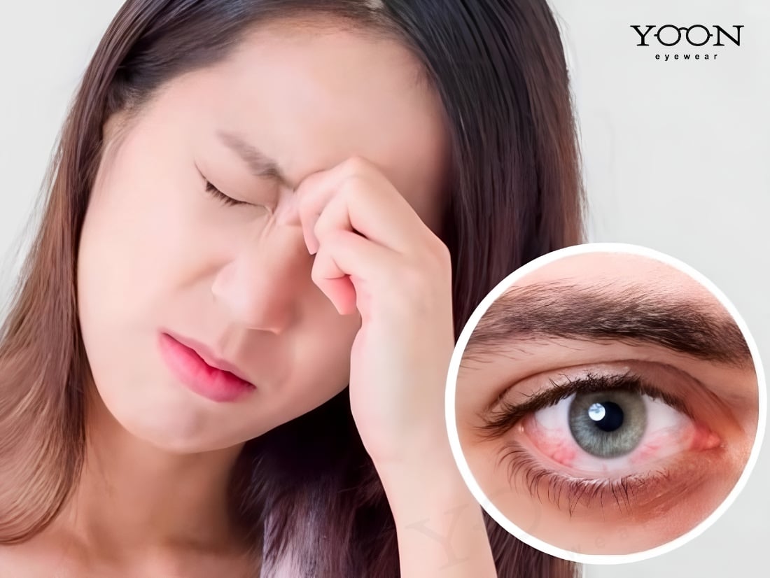 SÁNG NGỦ DẬY MẮT ĐỔ GHÈN NHIỀU CẢNH BÁO BỆNH GÌ?