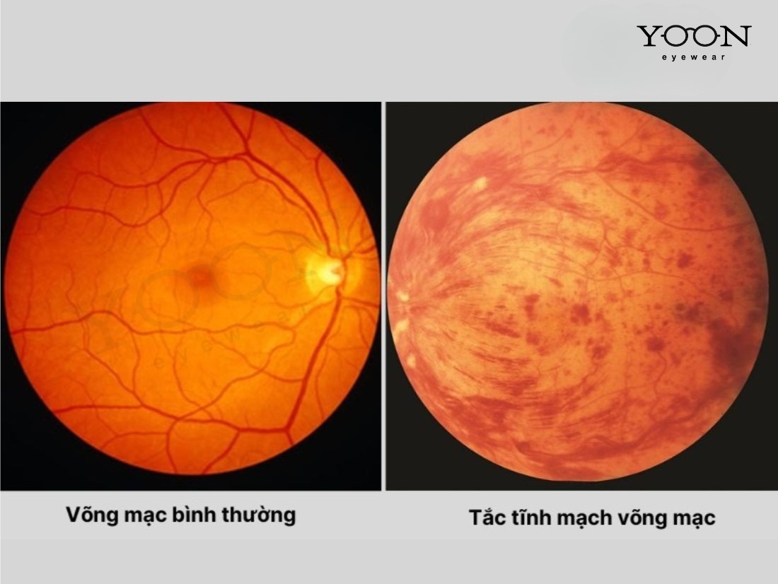 TẮC TĨNH MẠCH TRUNG TÂM VÕNG MẠC LÀ GÌ?