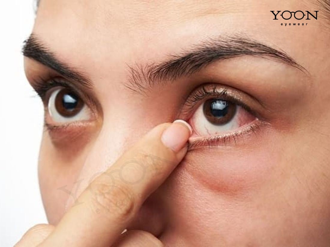 TRIỆU CHỨNG CỦA XUẤT HUYẾT VÕNG MẠC
