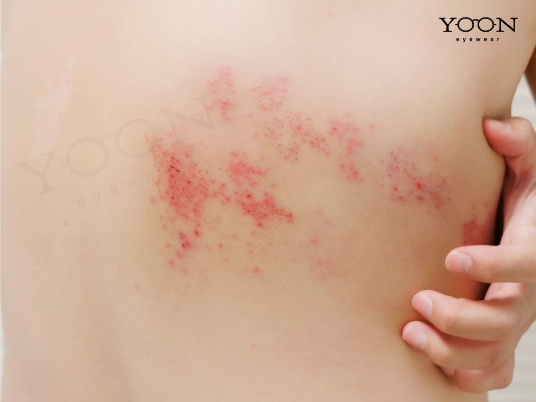TRIỆU CHỨNG CỦA ZONA THẦN KINH