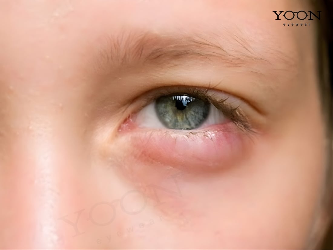 VIÊM BỜ MI LÀ GÌ?