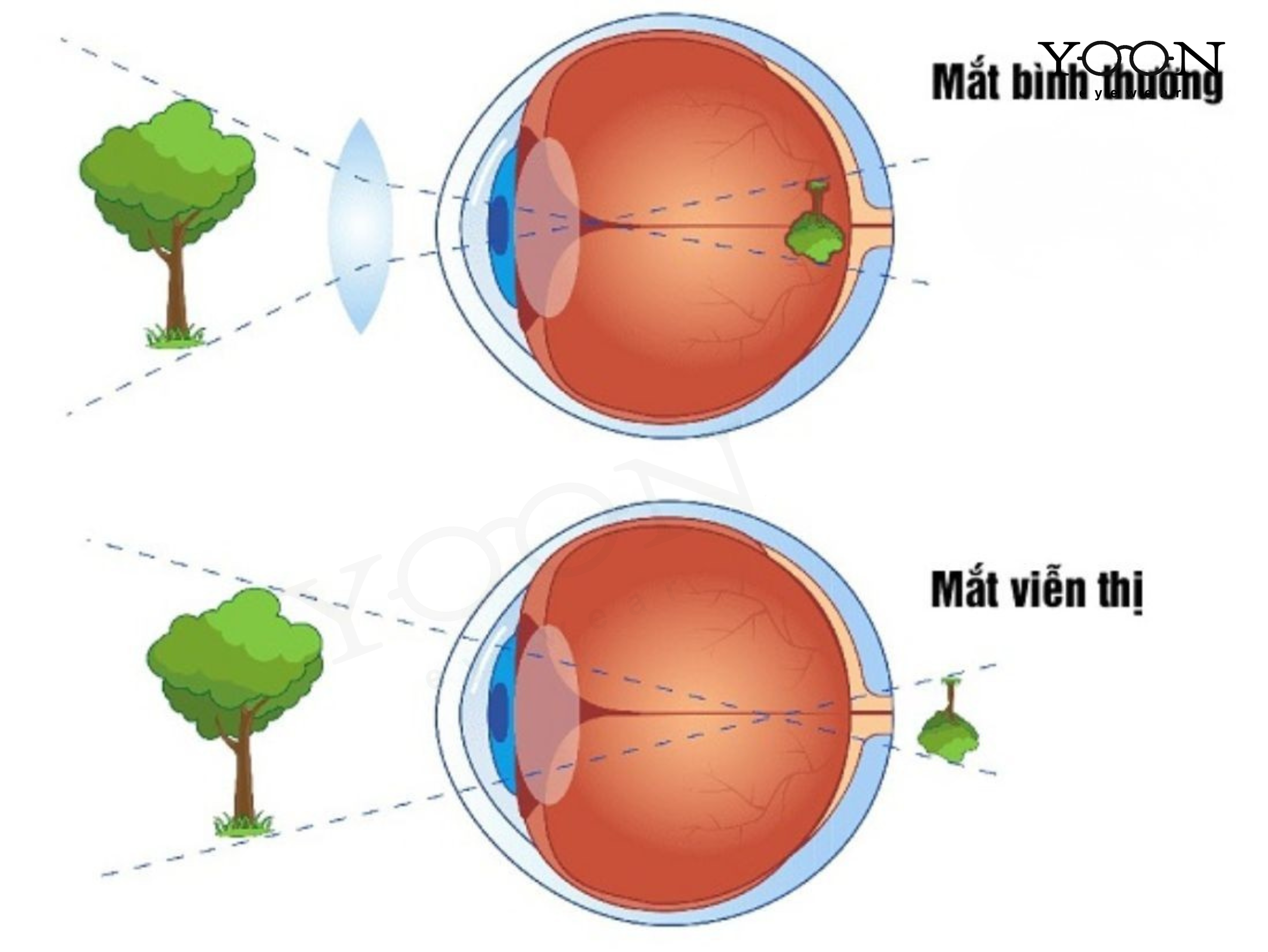 VIỄN THỊ LÀ GÌ VÀ VÌ SAO XẢY RA?