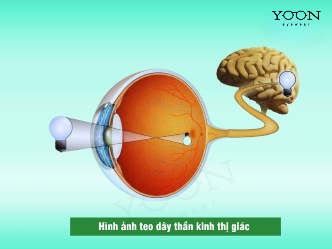 Viêm Dây Thần Kinh Thị Giác