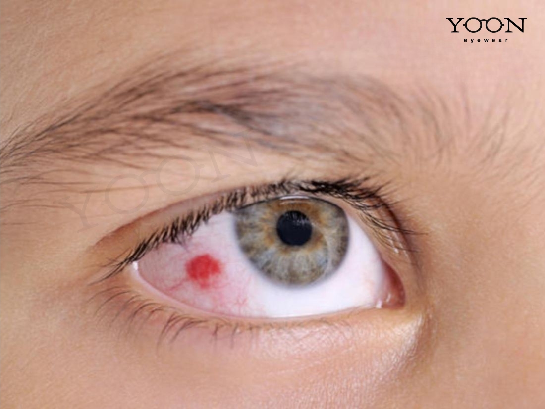 XƯỚC GIÁC MẠC LÀ GÌ?