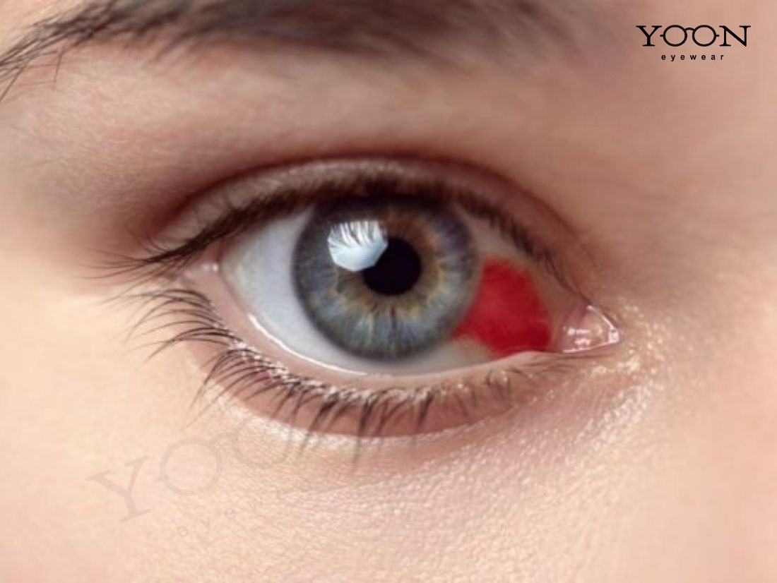 XUẤT HUYẾT VÕNG MẠC LÀ GÌ?