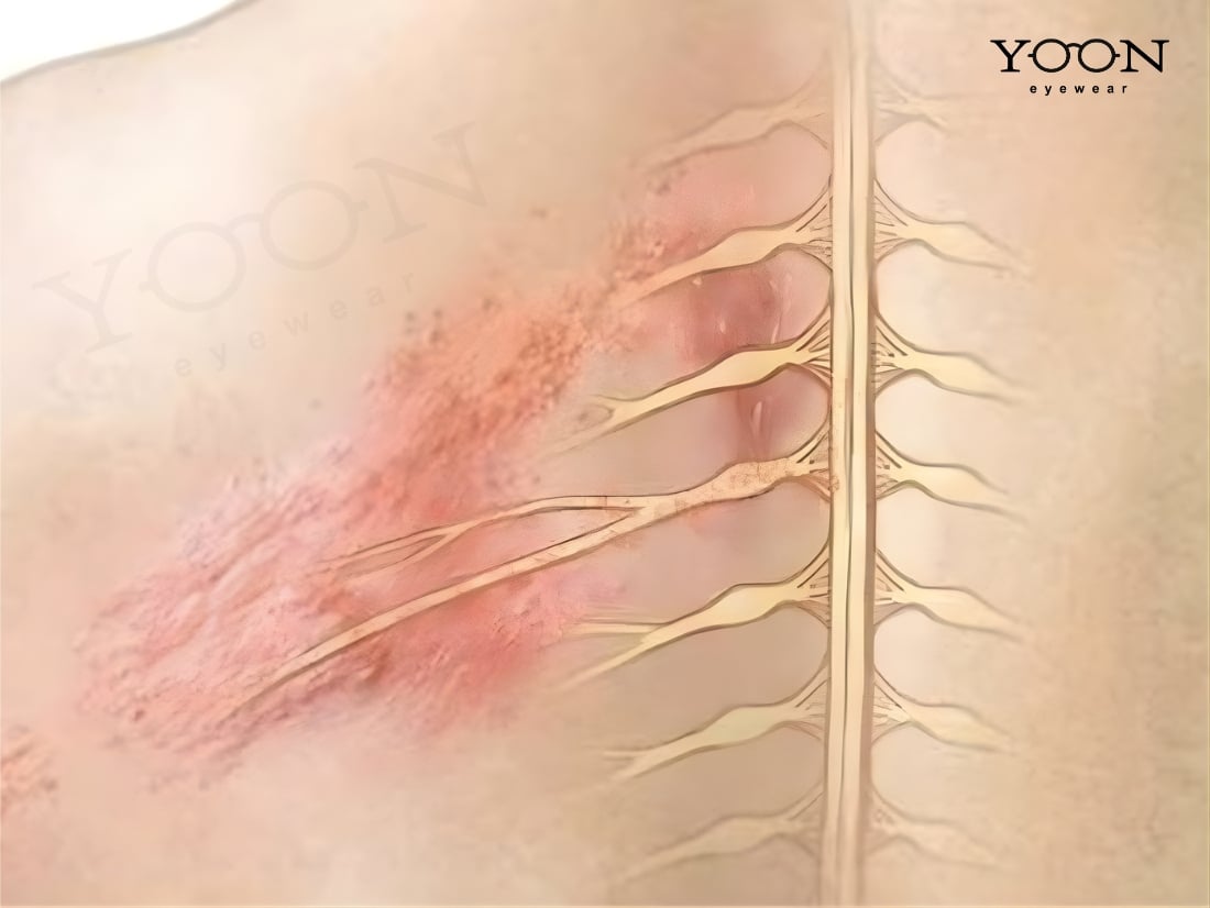 ZONA THẦN KINH LÀ BỆNH GÌ?