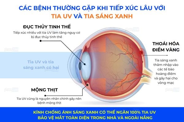 tia UV và ánh sáng xanh gây bệnh gì cho mắt
