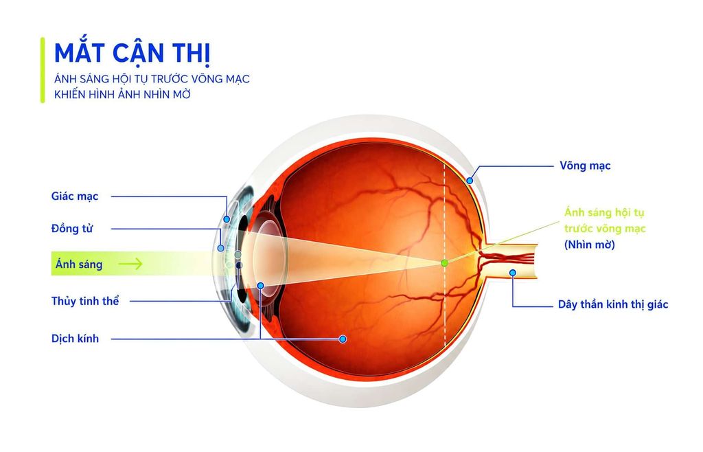 Mắt cận thị