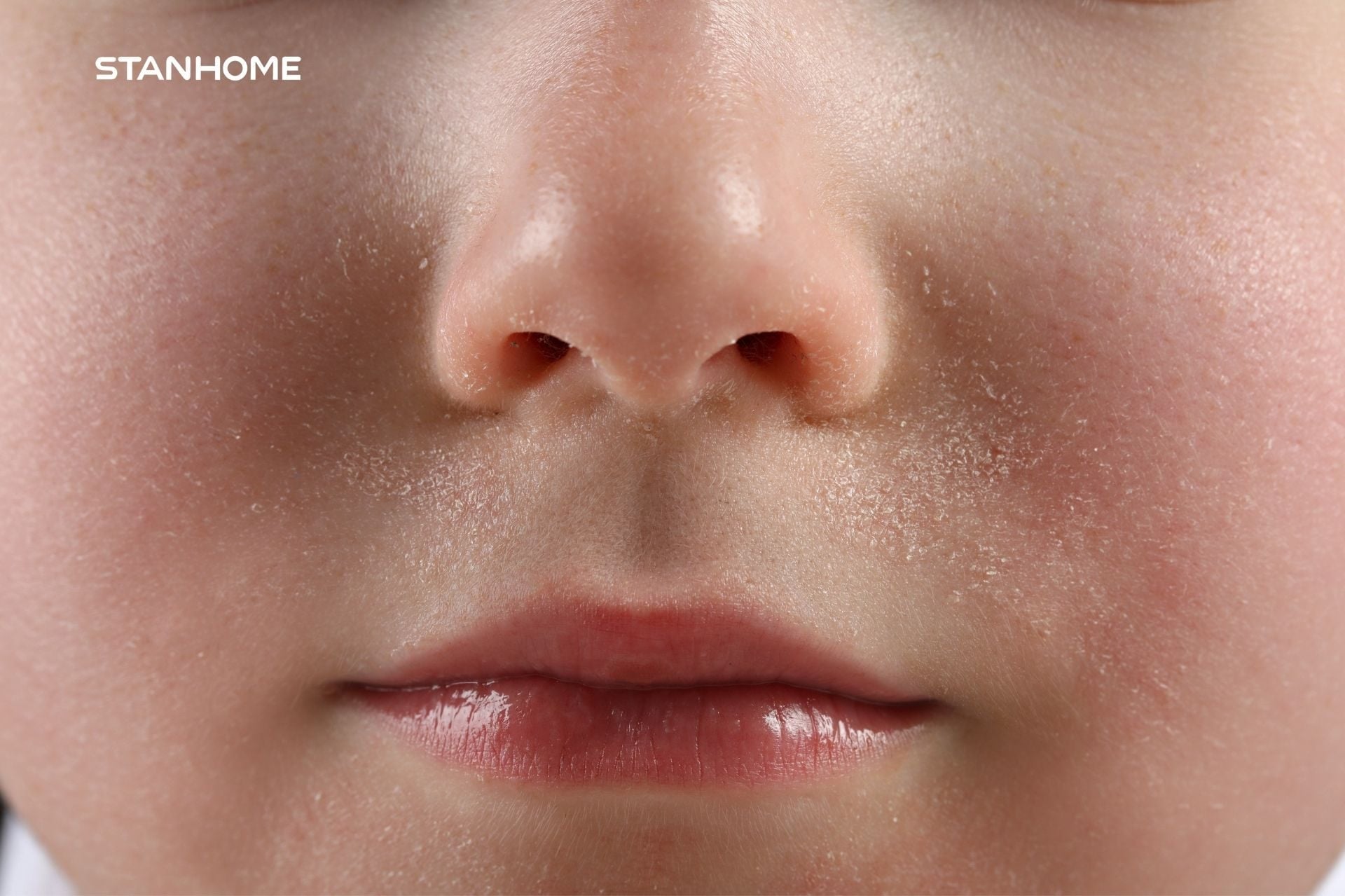 5 dấu hiệu da bạn đang thiếu ẩm mùa hanh khô