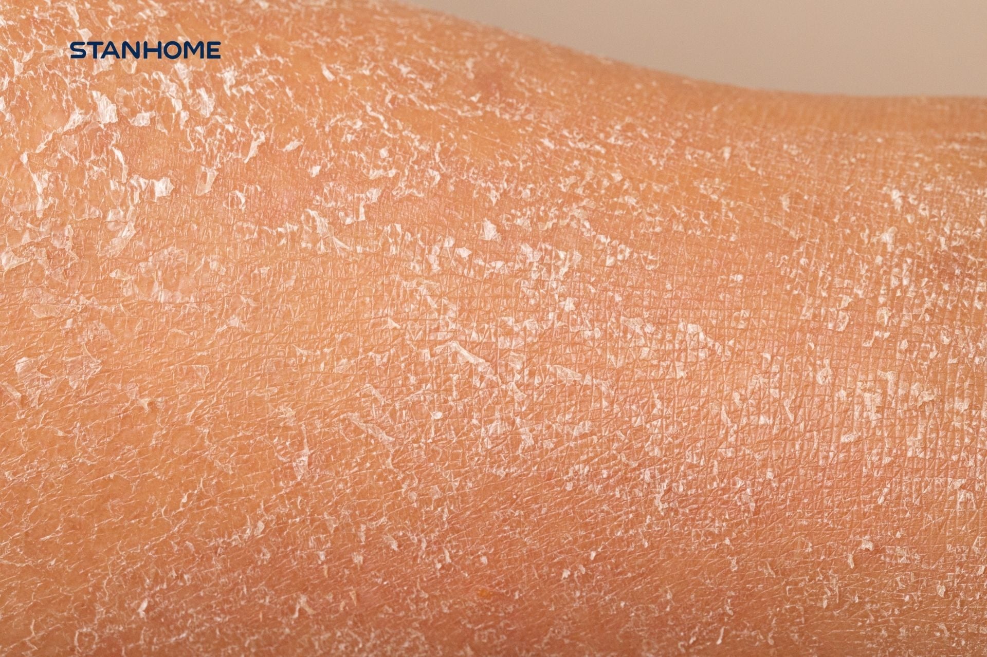 Tại sao da dễ khô bong tróc vào mùa hanh khô?