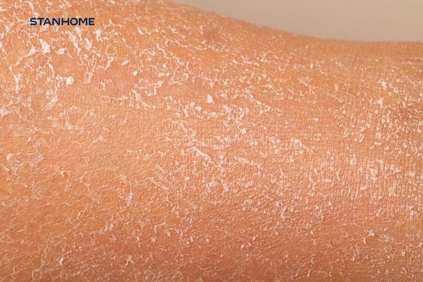 Tại sao da dễ khô bong tróc vào mùa hanh khô?
