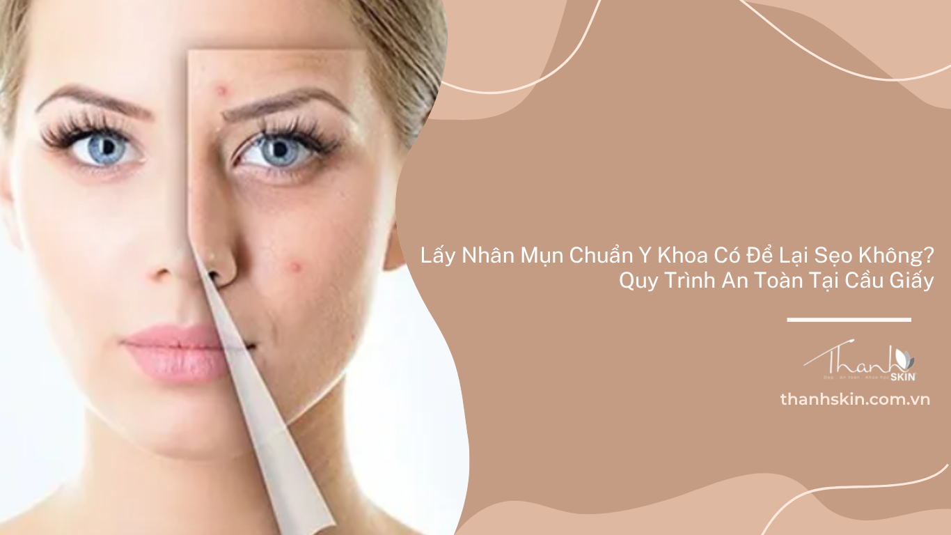 Lấy nhân mụn chuẩn y khoa có để lại thâm sẹo không? Quy trình an toàn tại Cầu Giấy