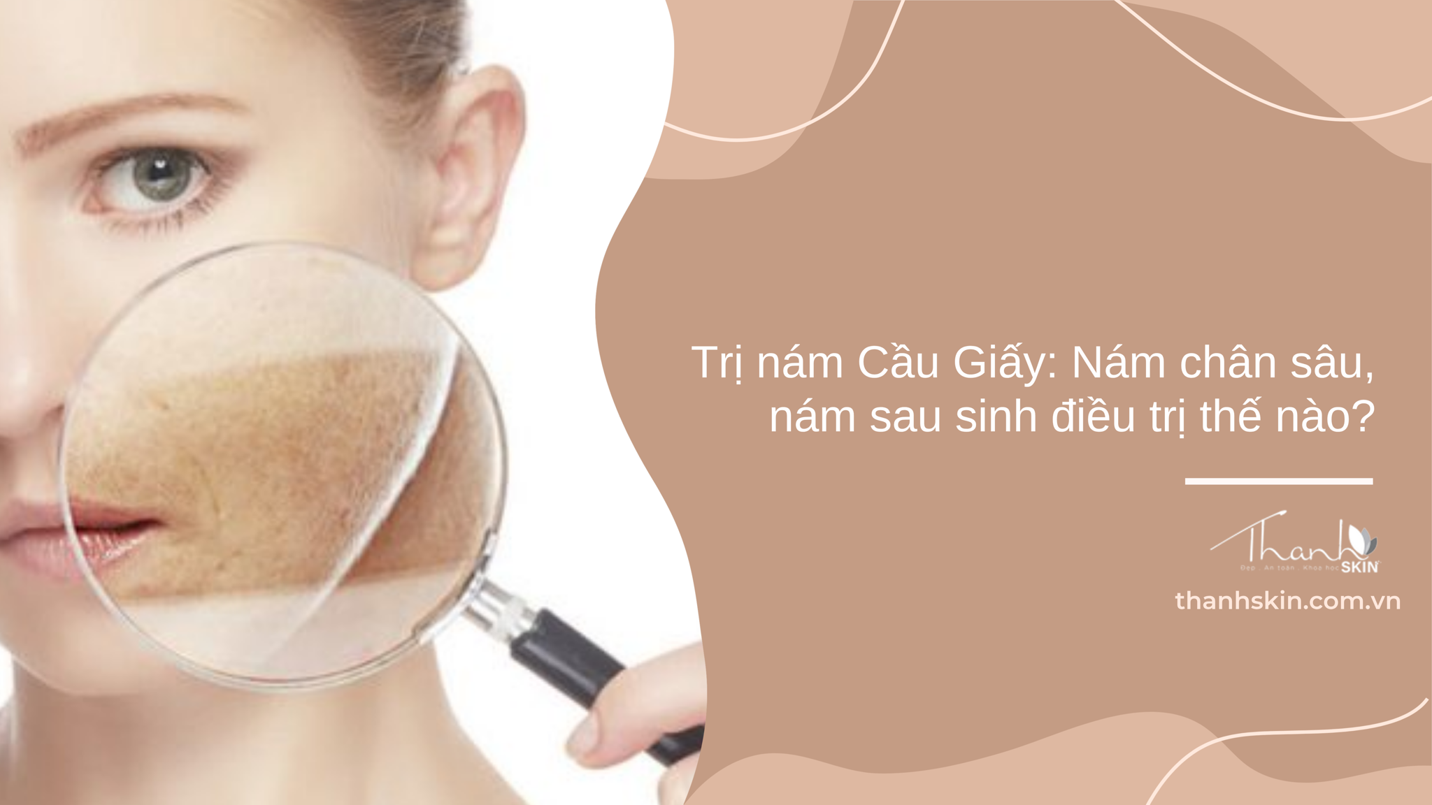 Trị nám Cầu Giấy: Nám chân sâu, nám sau sinh điều trị thế nào?