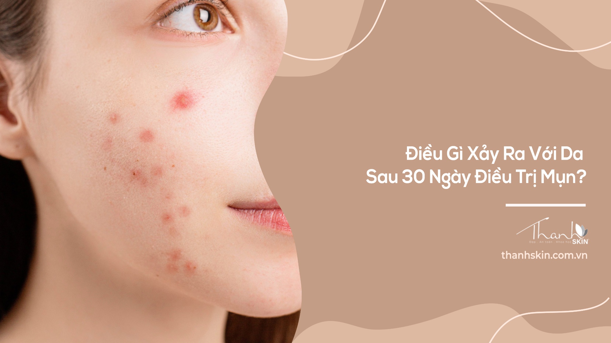 Điều Gì Xảy Ra Với Da Sau 30 Ngày Điều Trị Mụn?