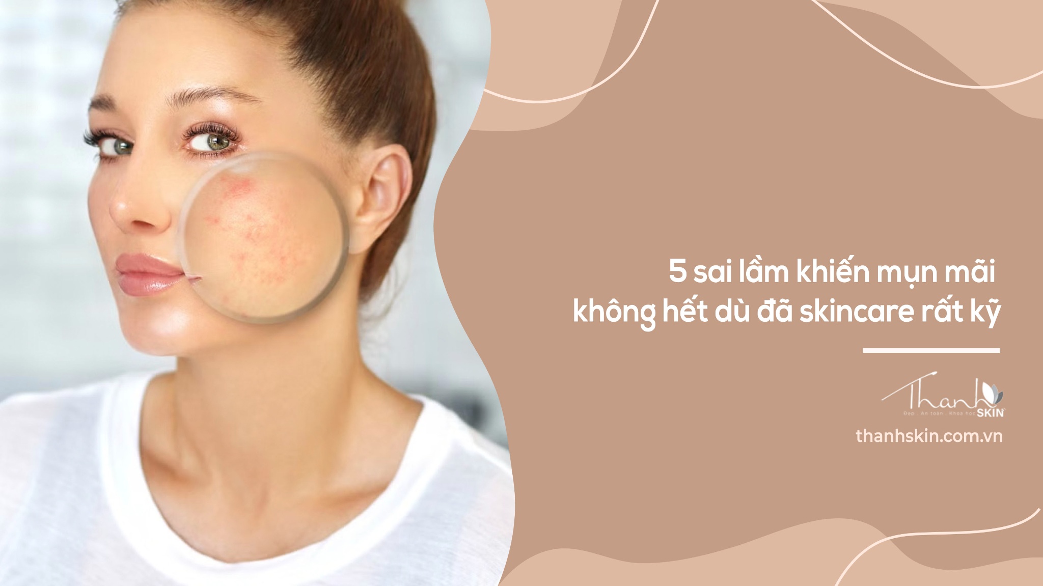 5 sai lầm khiến mụn mãi không hết dù đã skincare rất kỹ