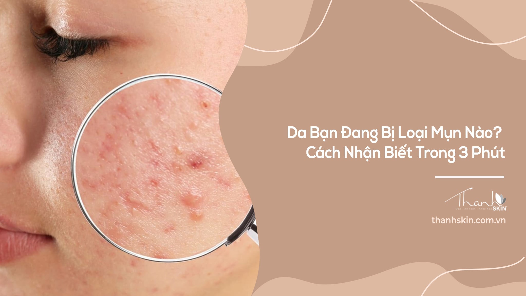 Da Bạn Đang Bị Loại Mụn Nào? Cách Nhận Biết Trong 3 Phút
