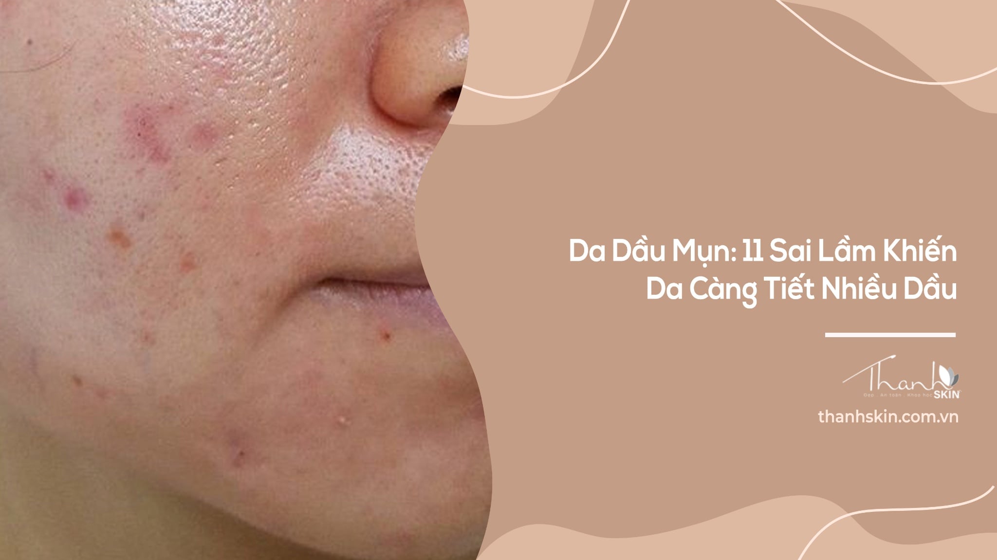 Da Dầu Mụn: 11 Sai Lầm Khiến Da Càng Tiết Nhiều Dầu