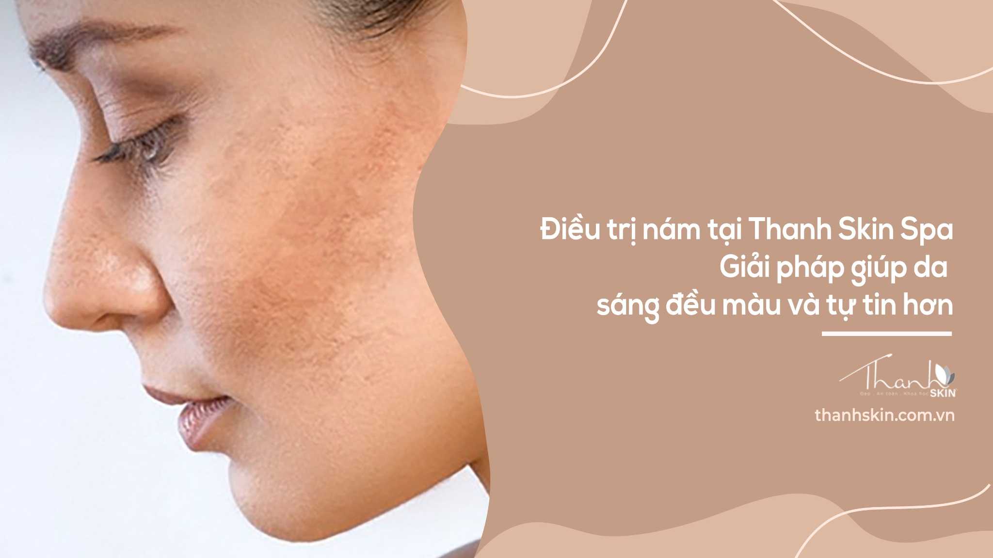 Điều trị nám tại Thanh Skin Spa | Da sáng đều màu, an toàn