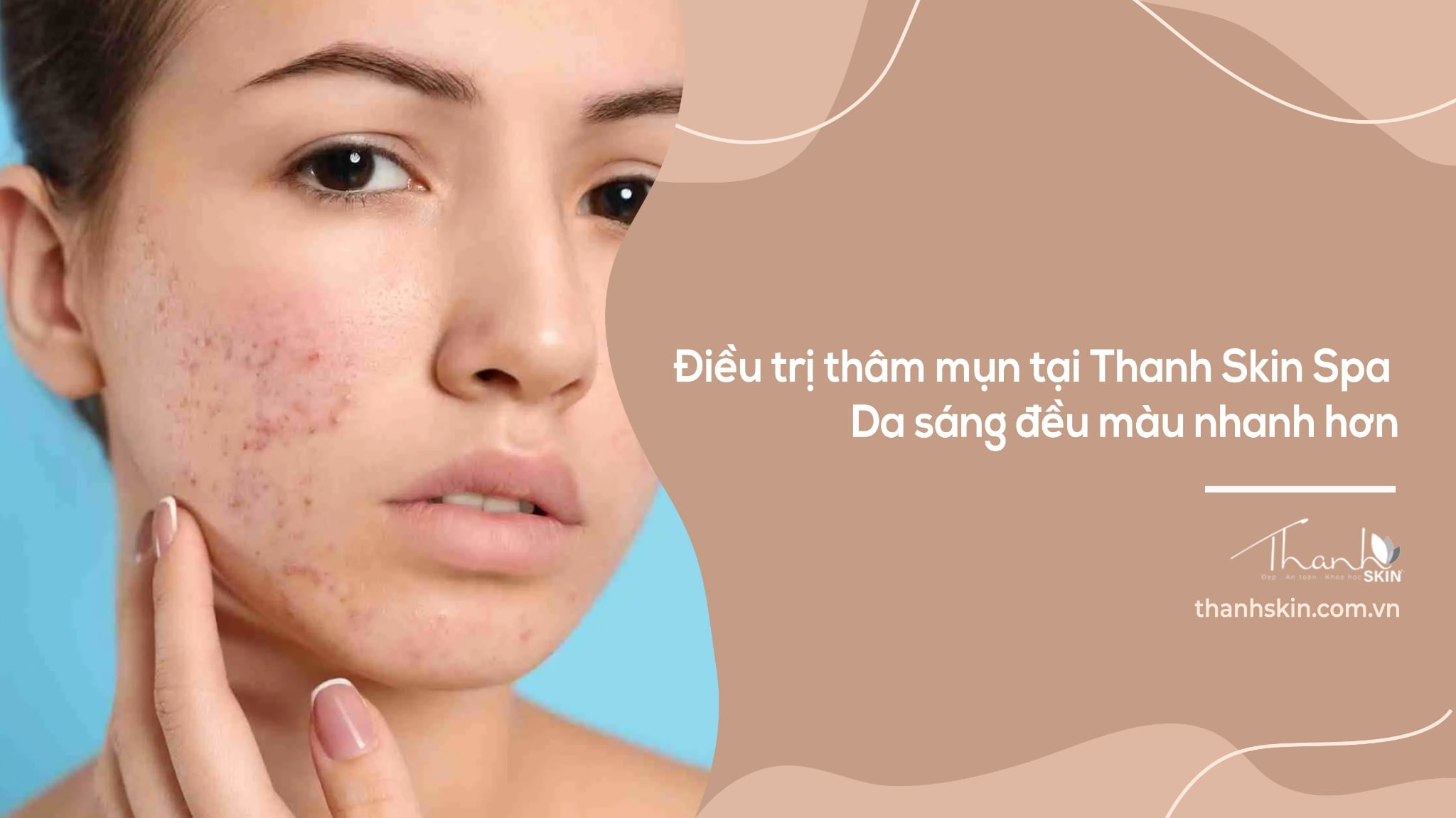 Điều trị thâm mụn tại Thanh Skin Spa | Da sáng đều màu nhanh hơn