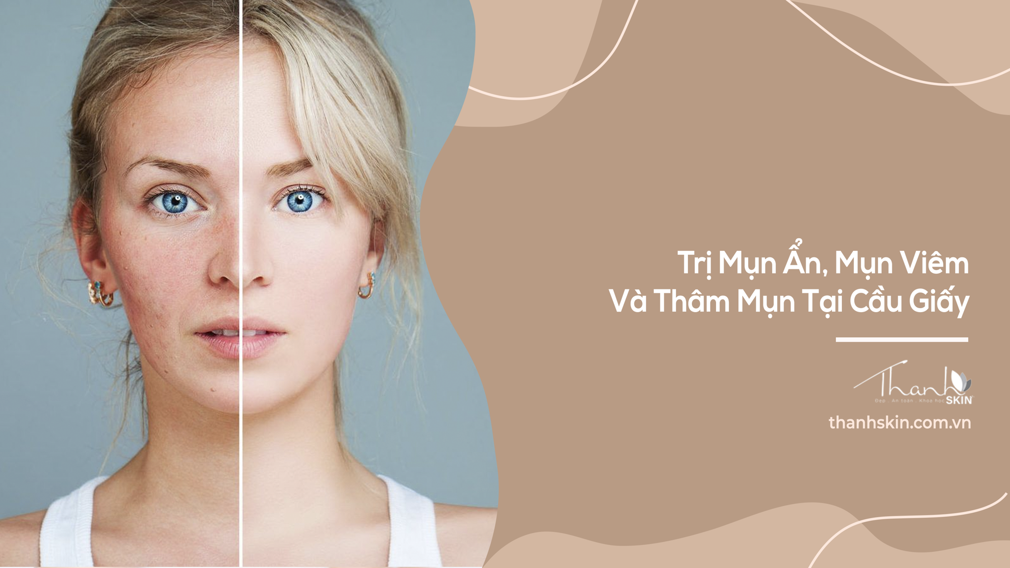 Trị Mụn Ẩn, Mụn Viêm Và Thâm Mụn Tại Cầu Giấy