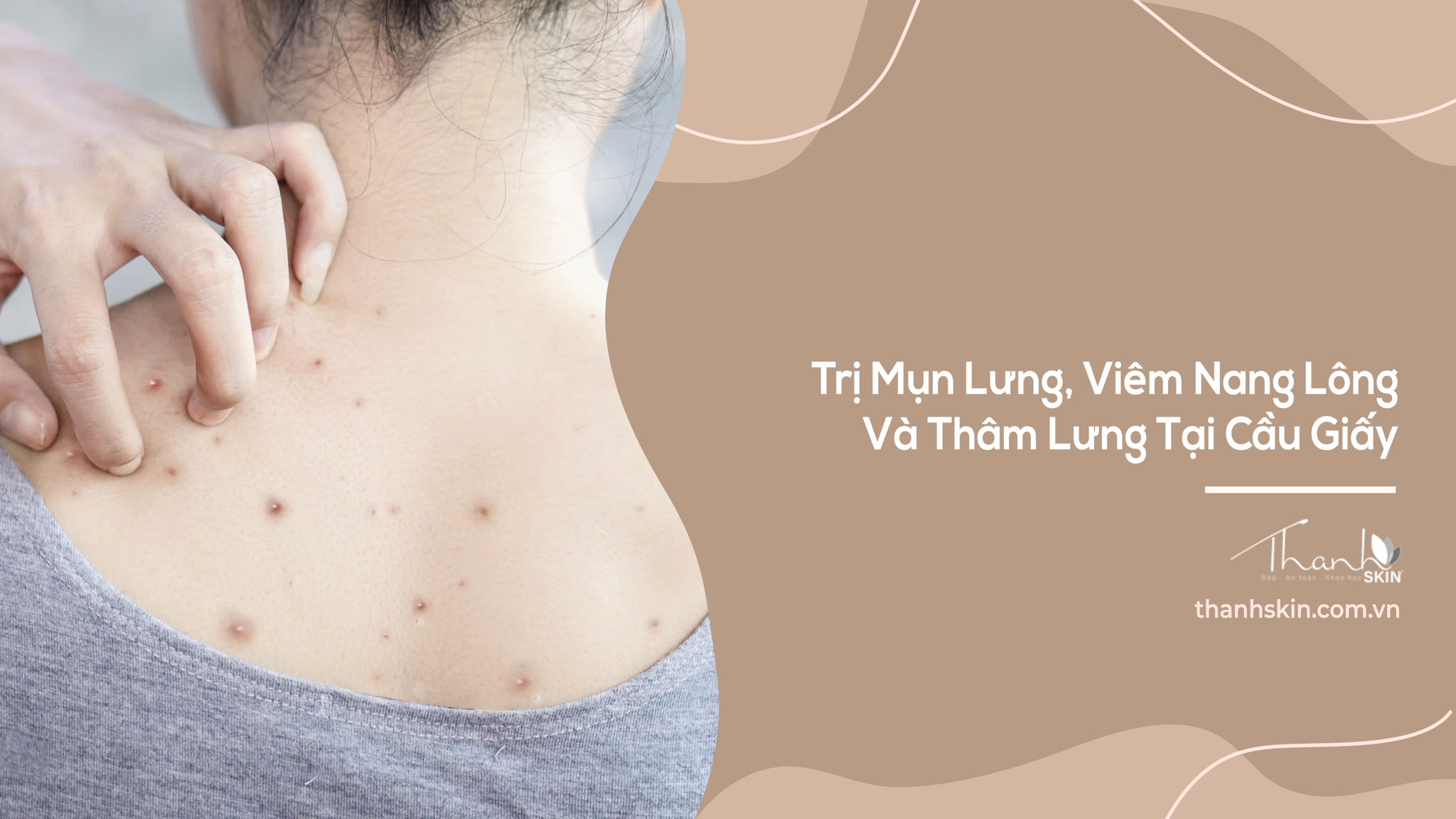 Trị Mụn Lưng, Viêm Nang Lông Và Thâm Lưng Tại Cầu Giấy