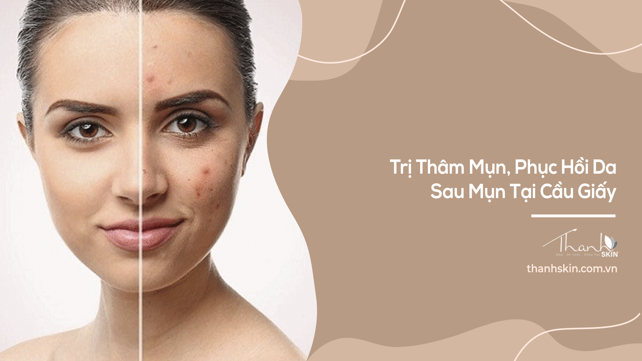 Trị Thâm Mụn, Phục Hồi Da Sau Mụn Tại Cầu Giấy