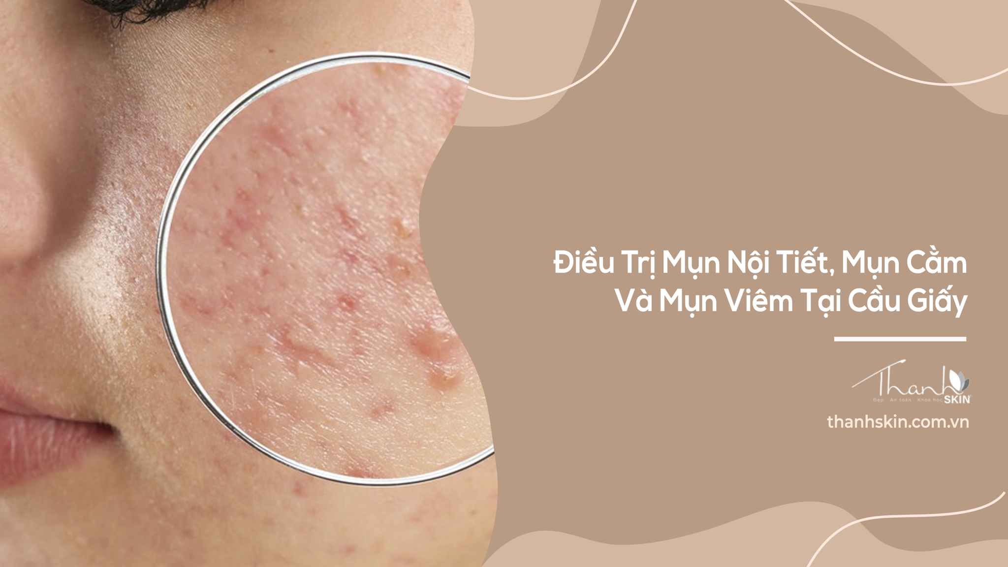 Điều Trị Mụn Nội Tiết, Mụn Cằm Và Mụn Viêm Tại Cầu Giấy
